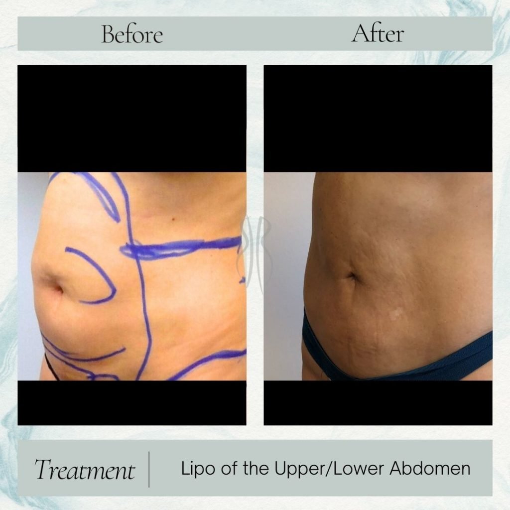 Stomach Lipo