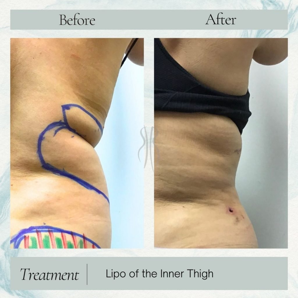 Lipo of Love Handles