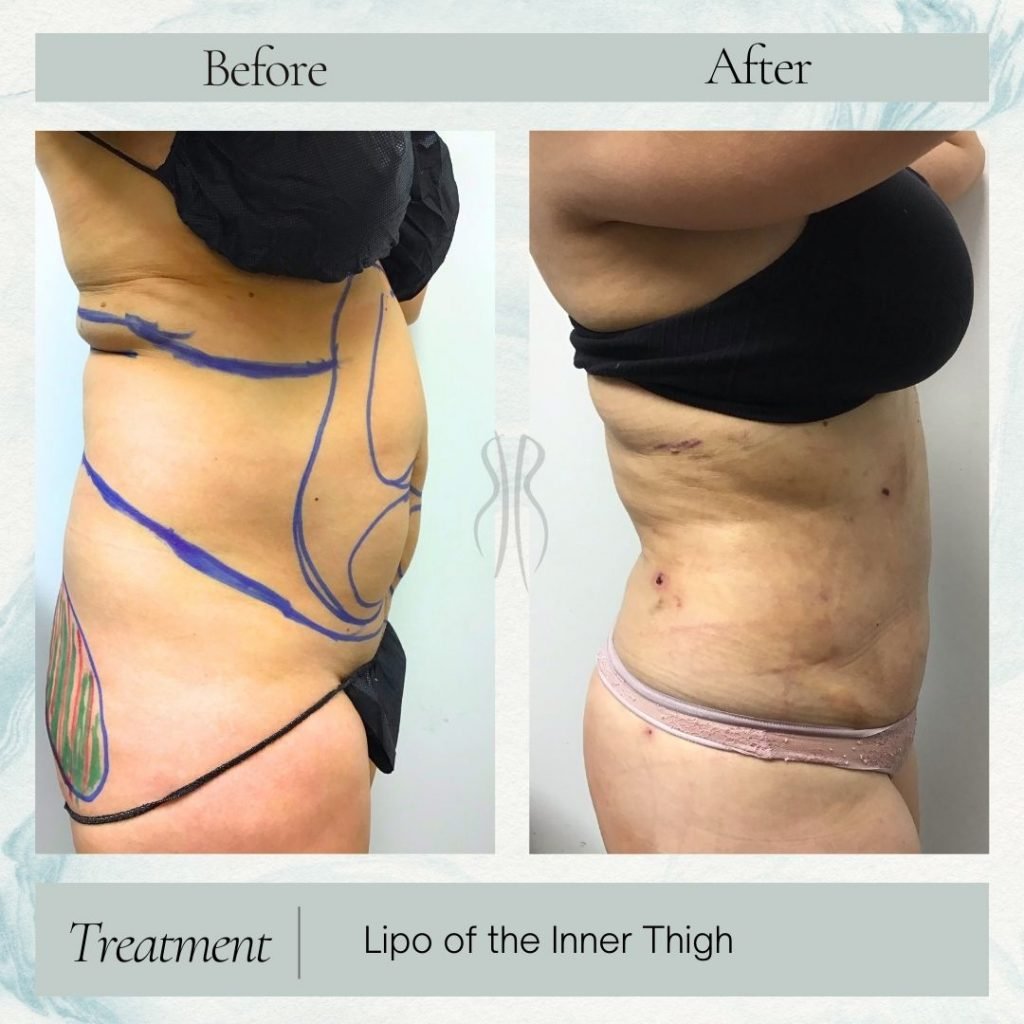 Lipo of inner Thighs