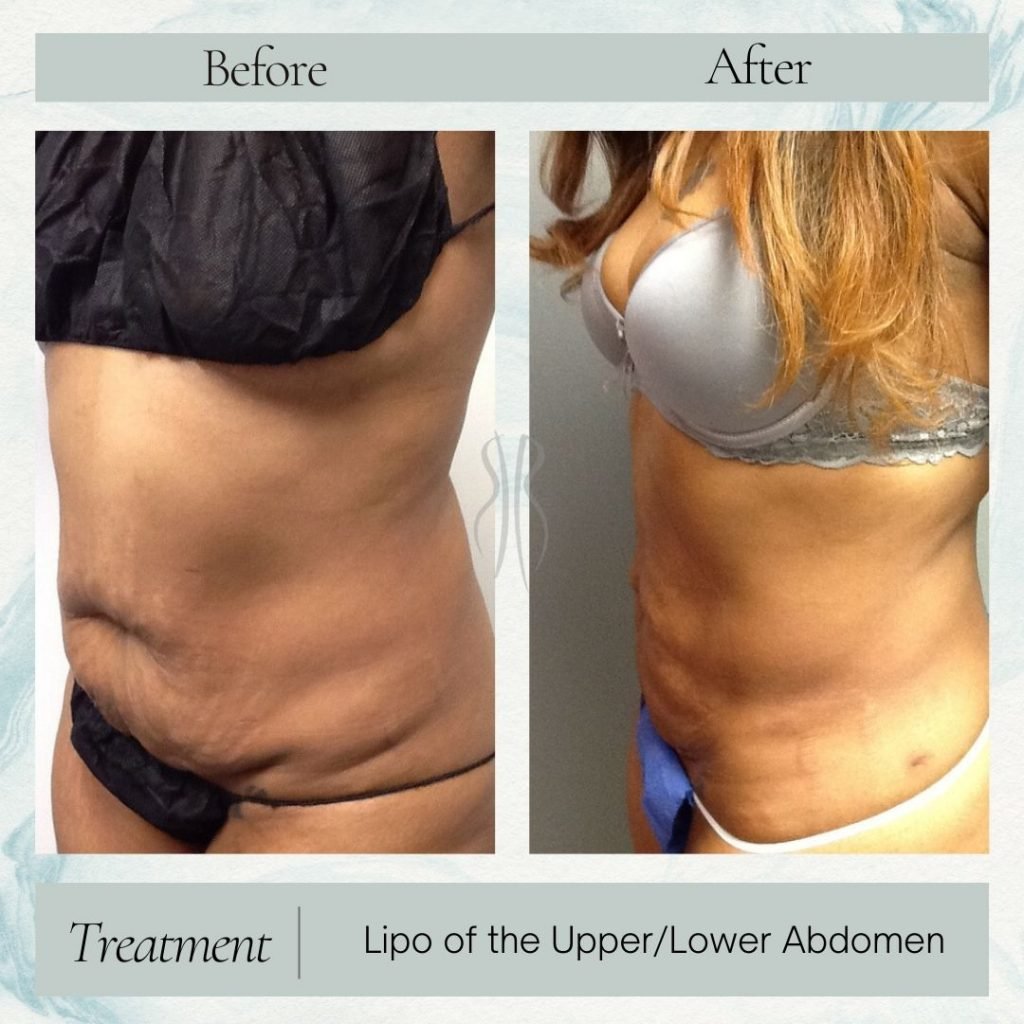 Abdomen Lipo