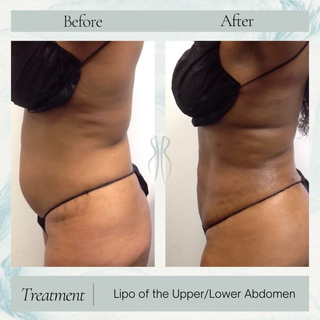 upper/lower Abdomen Lipo