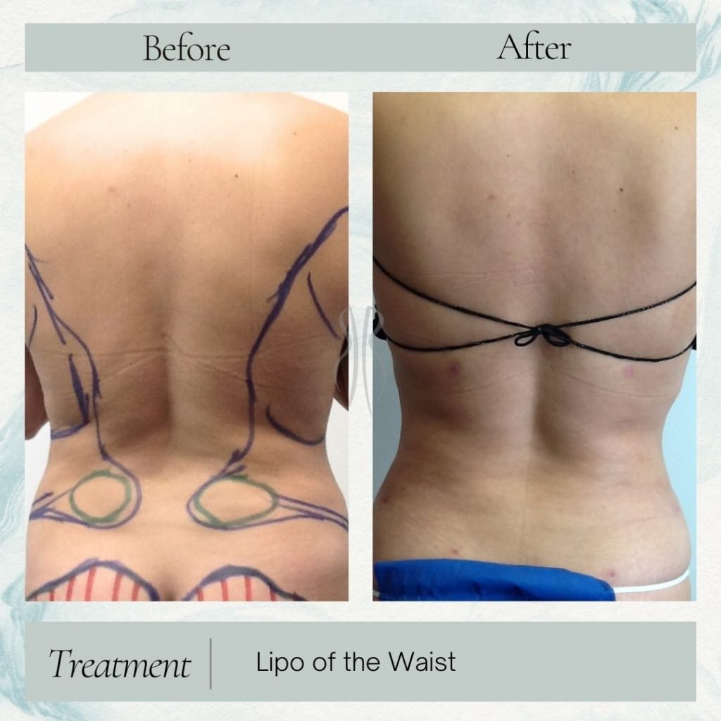 Lipo of Waist