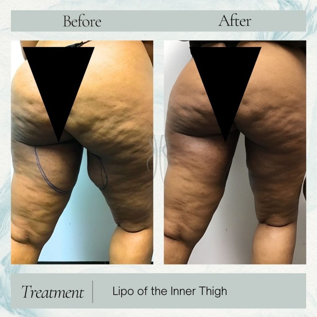 Lipo of Inner Thigh